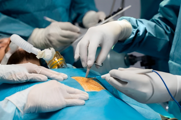 gall stone surgery